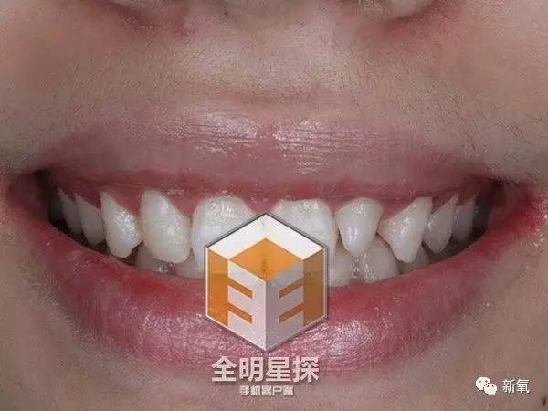 林允整牙却像整容?她是真的又整了啊!