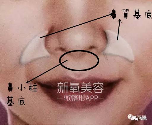 林允整牙却像整容?她是真的又整了啊!