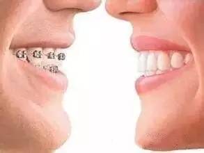 腺样体牙齿矫正最佳年龄,地包天牙齿矫正最佳年龄