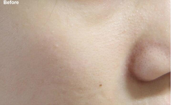 肌肤上的污垢怎么去除,白头粉刺正确消除方法