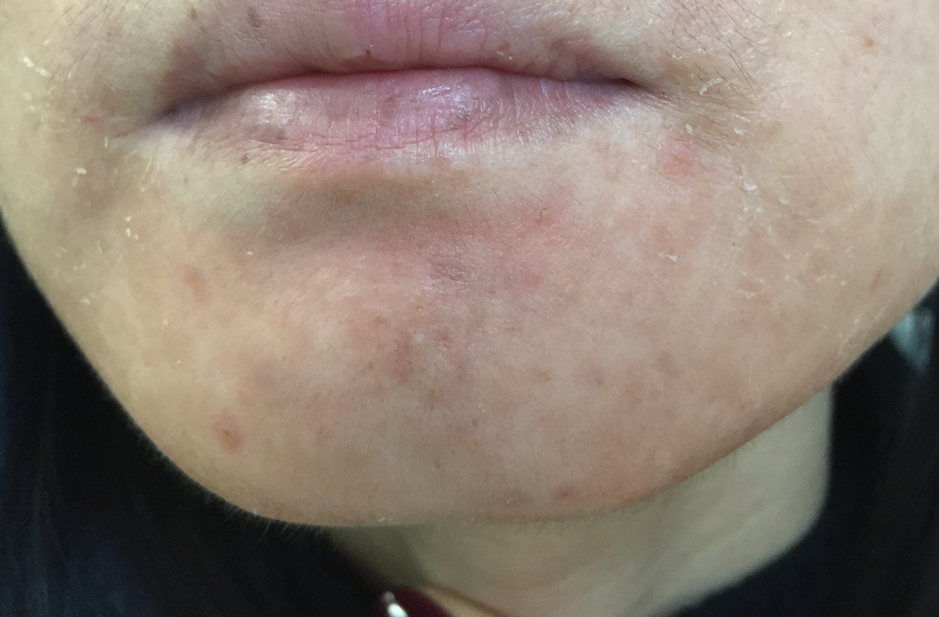 治疗青春痘最好的药是什么,治疗青春痘十大有效的药