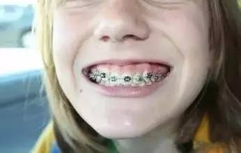 腺样体牙齿矫正最佳年龄,地包天牙齿矫正最佳年龄