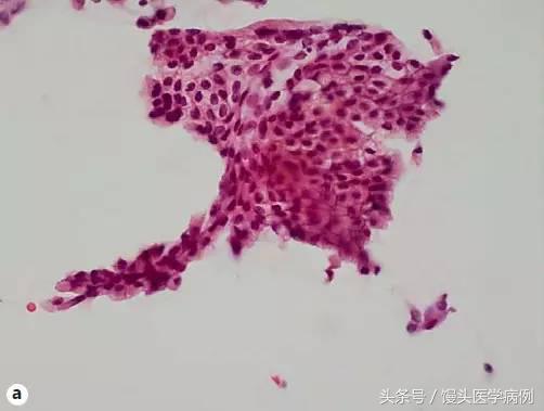 卵巢肿瘤穿刺活检结果,卵巢囊肿穿刺从哪穿刺