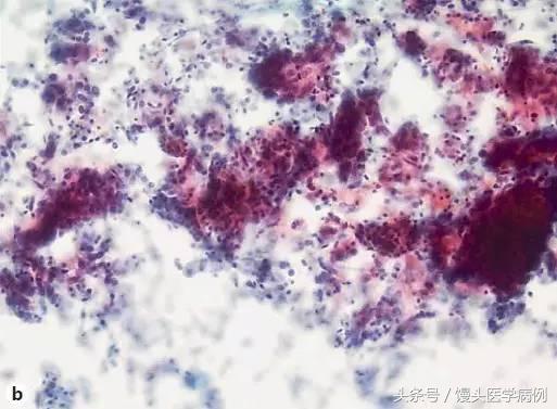 卵巢肿瘤穿刺活检结果,卵巢囊肿穿刺从哪穿刺