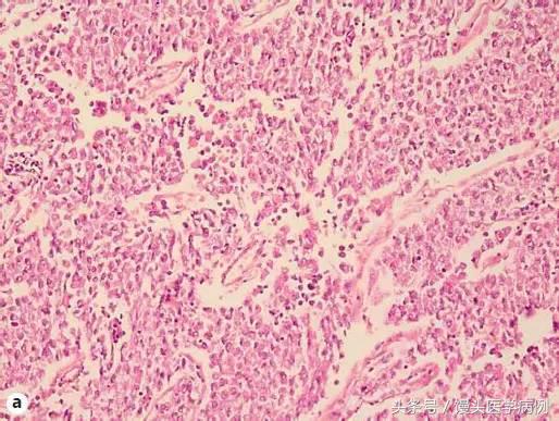 卵巢肿瘤穿刺活检结果,卵巢囊肿穿刺从哪穿刺