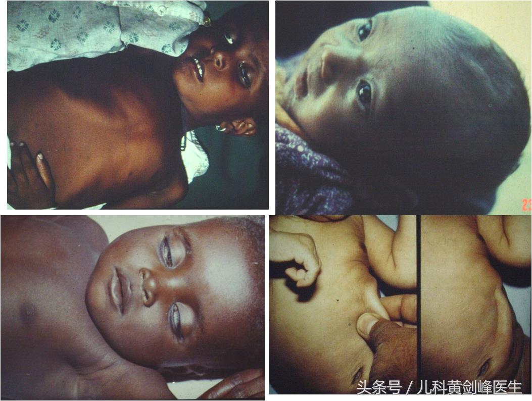 小儿腹泻的补液原则是什么,儿童腹泻的治疗原则是什么