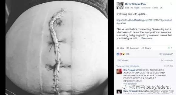 先别被图片吓到,这位剖腹产妈妈的自白让无数人感动