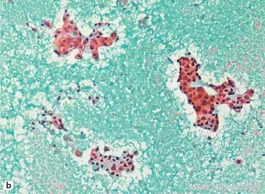 卵巢肿瘤穿刺活检结果,卵巢囊肿穿刺从哪穿刺