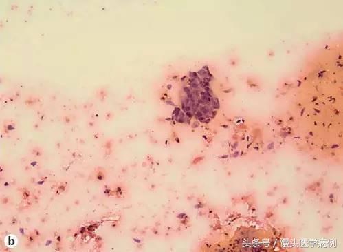 卵巢肿瘤穿刺活检结果,卵巢囊肿穿刺从哪穿刺