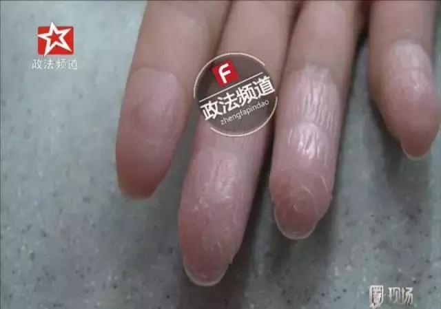 蹇冪柤鍖绘姢浜哄憳鐨勬墜,蹇冪柤绮楃硻鐨勬墜