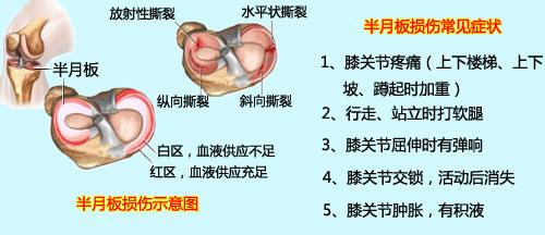 半月板的知识大全,半月板如何治疗才能恢复如初