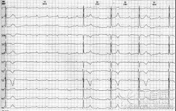 漫话心律失常：窦性心律没你想得那么简单