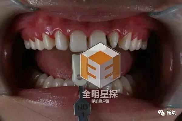 林允整牙却像整容?她是真的又整了啊!