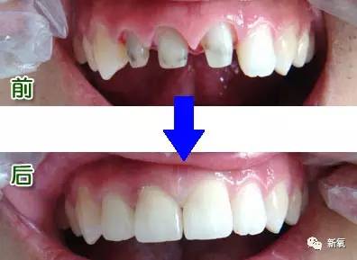 林允整牙却像整容?她是真的又整了啊!