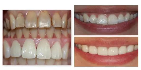 林允整牙却像整容?她是真的又整了啊!