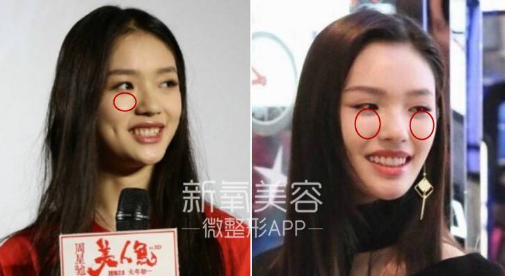 林允整牙却像整容?她是真的又整了啊!