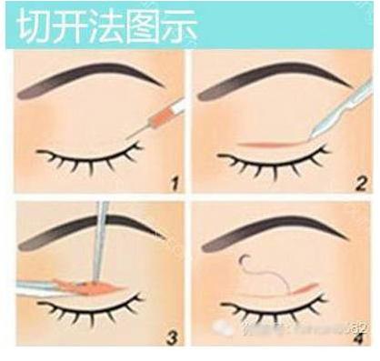 日本纳米无痕双眼皮加开眼角,纳米无痕双眼皮15天恢复图