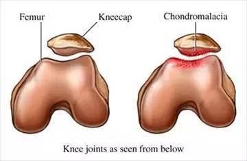 髌骨软化症最佳的治疗方法,夹球可以锻炼髌骨软化症吗