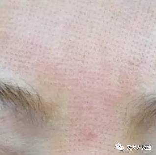 黑脸娃娃收缩毛孔,收缩毛孔黑脸娃娃