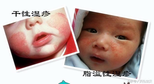 宝宝湿疹妈妈的心酸,宝妈湿疹的亲身经历