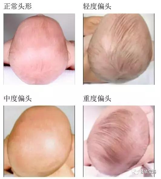 宝宝头型睡偏头了怎么调整过来,婴儿睡觉偏头怎么纠正图文