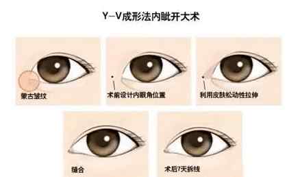 双眼皮割得不好看怎么补救,双眼皮割得不自然怎么办