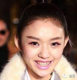 林允整牙却像整容?她是真的又整了啊!