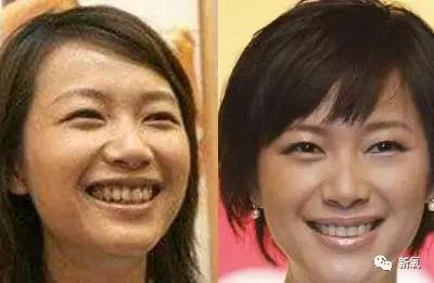 林允整牙却像整容?她是真的又整了啊!