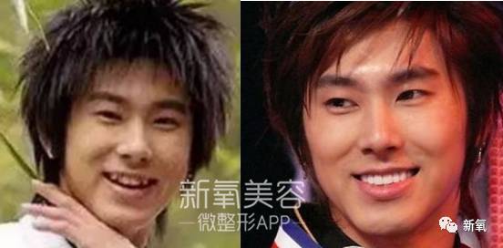 林允整牙却像整容?她是真的又整了啊!