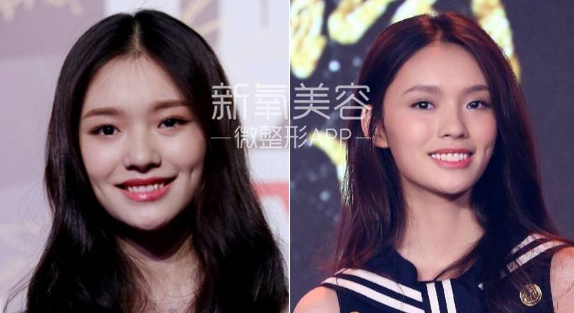 林允整牙却像整容?她是真的又整了啊!