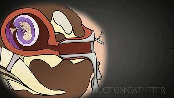 人工流产、药物流产哪种流产更安全？