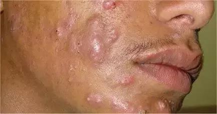 是不是有创面就会有疤痕,是不是痘痘下去了有痘坑