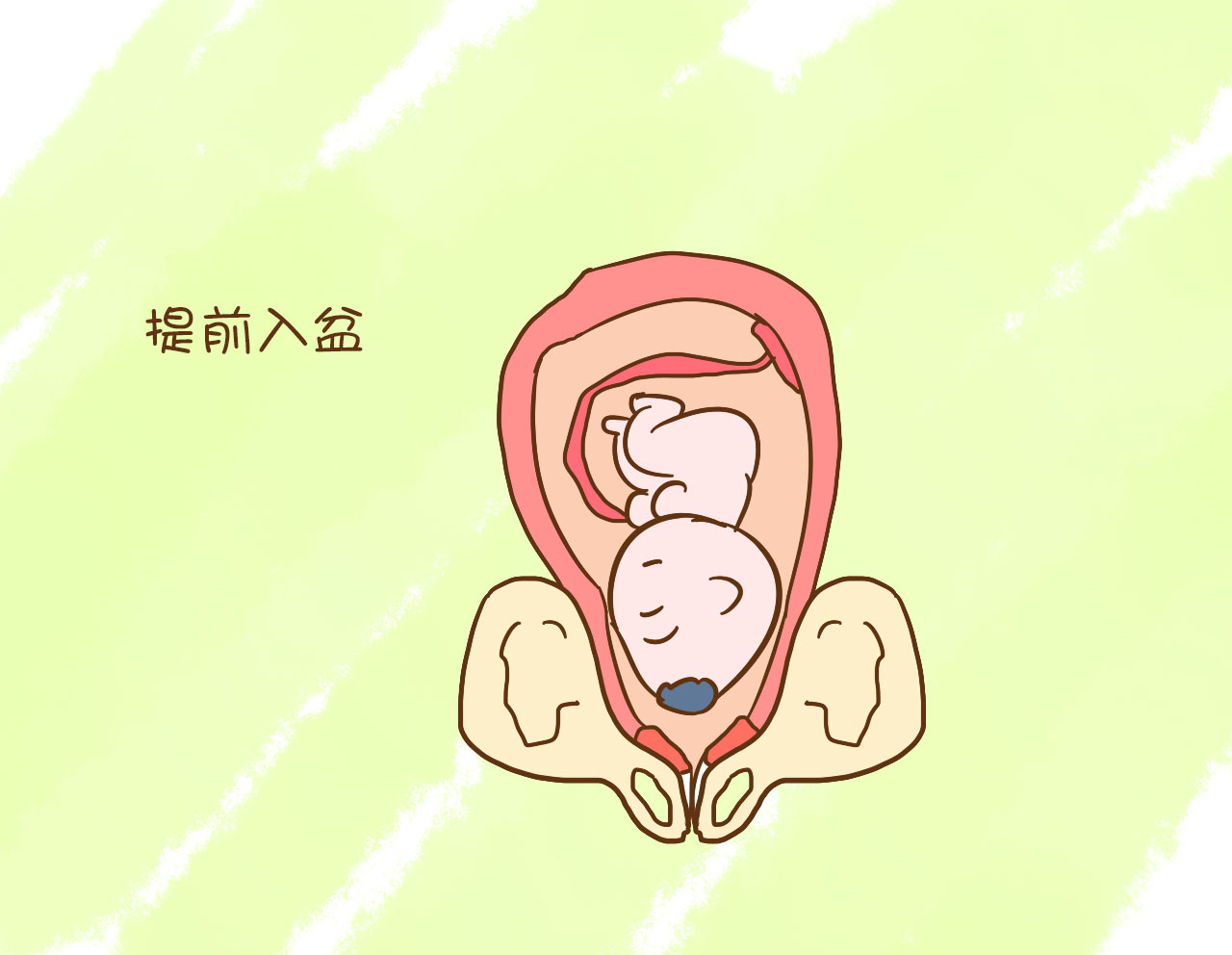 半入盆后怎样才能让胎儿快速入盆,医生说胎儿已入骨盆什么时候能生