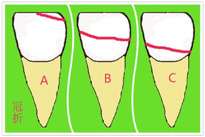 牙齿骨折后能自然愈合吗,骨折可以彻底痊愈吗