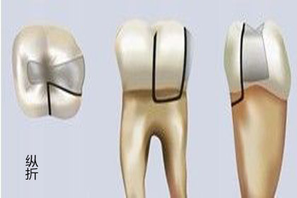 牙齿骨折后能自然愈合吗,骨折可以彻底痊愈吗