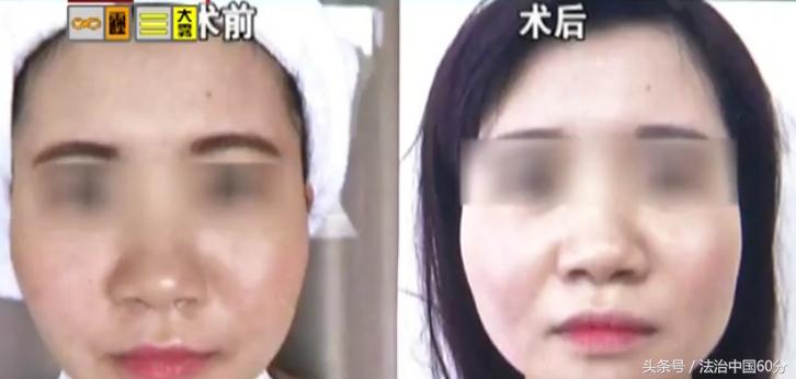 打3年瘦脸针现在方脸变瓜子脸,瘦脸针怎么让脸变瘦的