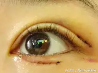 小女孩总是两眼泪汪汪……原来是睫毛“逆生长”