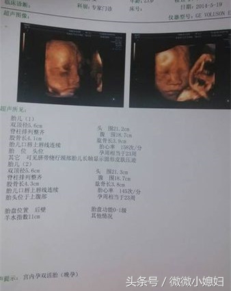 终于成功诞下‘龙凤胎’有了‘平安银行’，分享产程和症状