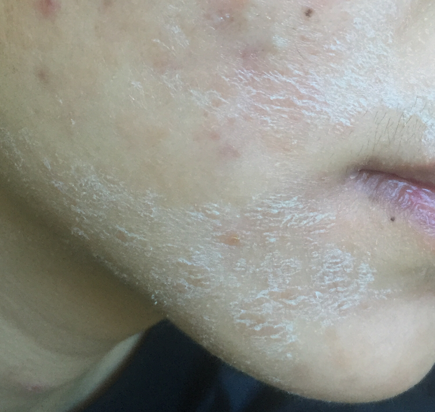 治疗青春痘最好的药是什么,治疗青春痘十大有效的药