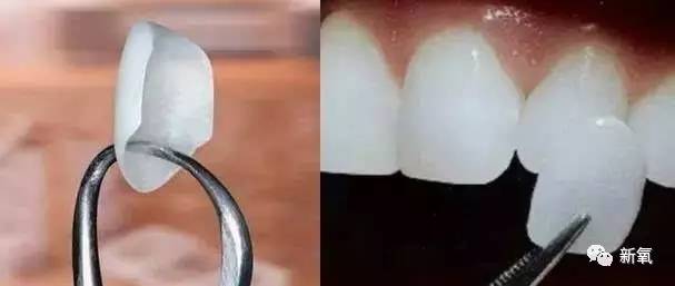 林允整牙却像整容?她是真的又整了啊!