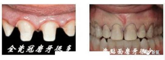 林允整牙却像整容?她是真的又整了啊!