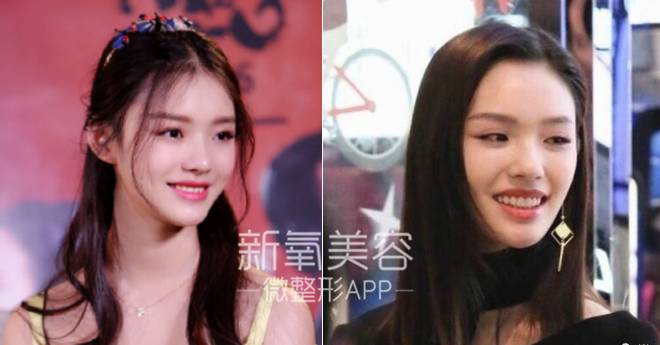 林允整牙却像整容?她是真的又整了啊!