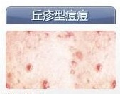 如何有效避免或减少青春痘的出现,避免青春痘误区彻底治疗青春痘