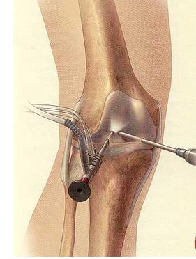 髌骨软化症最佳的治疗方法,夹球可以锻炼髌骨软化症吗