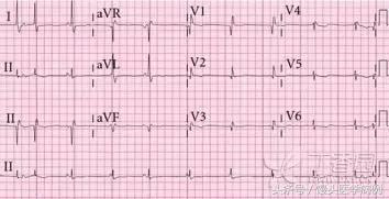 漫话心律失常：窦性心律没你想得那么简单