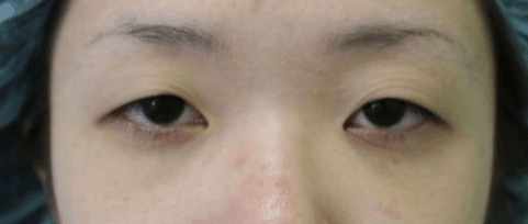 双眼皮割得不好看怎么补救,双眼皮割得不自然怎么办