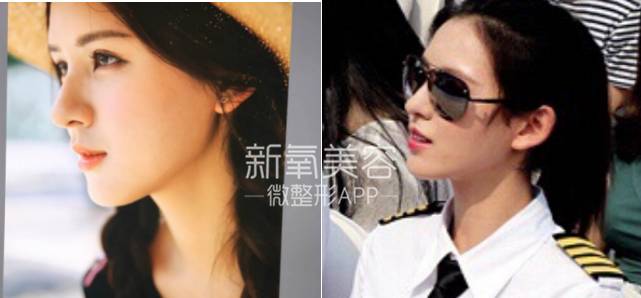 林允整牙却像整容?她是真的又整了啊!