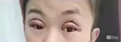 日本纳米无痕双眼皮加开眼角,纳米无痕双眼皮15天恢复图