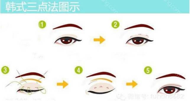 日本纳米无痕双眼皮加开眼角,纳米无痕双眼皮15天恢复图