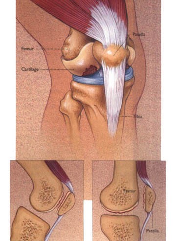 髌骨软化症最佳的治疗方法,夹球可以锻炼髌骨软化症吗